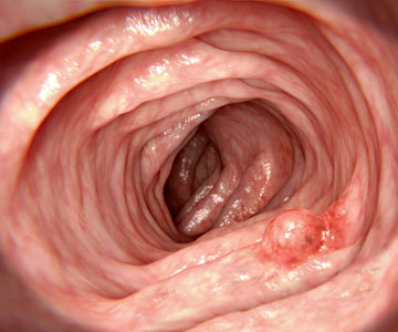 Colonoscopy polyp