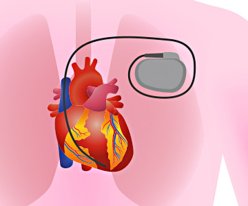 Illustration of human heart with cardiac pacemaker.