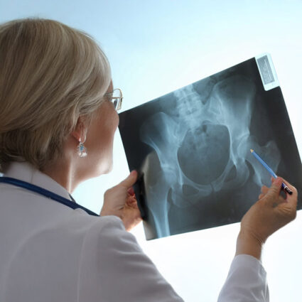 An orthopedic surgeon reviews a hip x-ray in front of a light board.