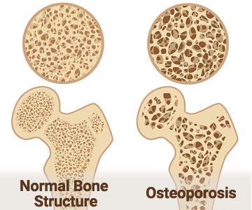 An illustration showing the interior structure of health bone next to a bone with osteoporosis.