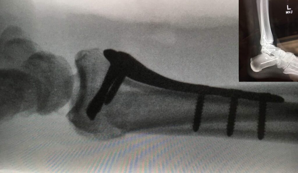 An x-ray showing the pins in Kent's fractured ankle.