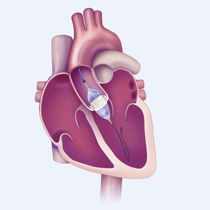 Heart illustration showing TAVR procedure