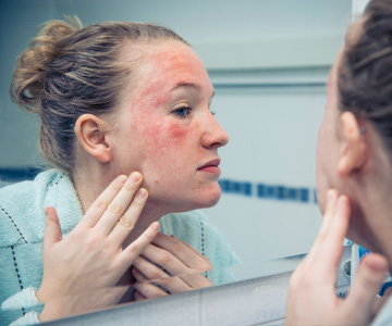 Woman looking in mirror at a red allergic rash on her face.